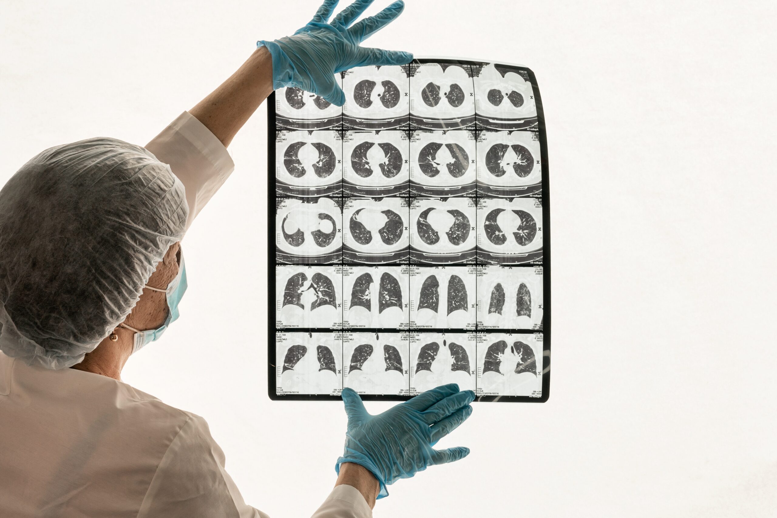 Benefits of CT Lung Screening in Beverly Hills