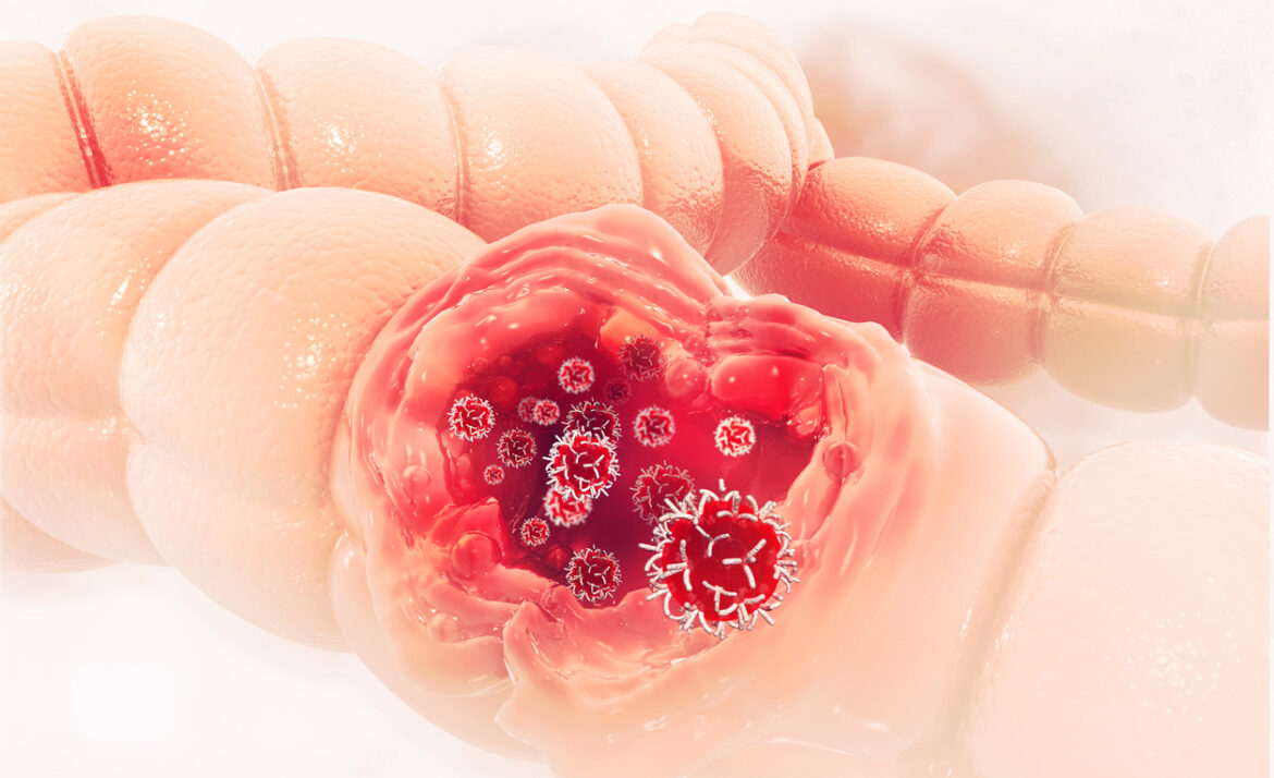 Schedule a Virtual Colonoscopy in Beverly Hills or Santa Monica, CA