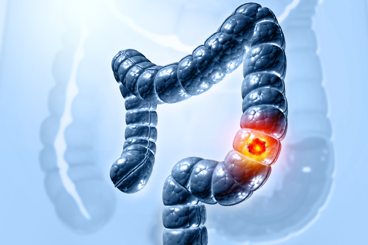 virtual colonoscopy Beverly Hills