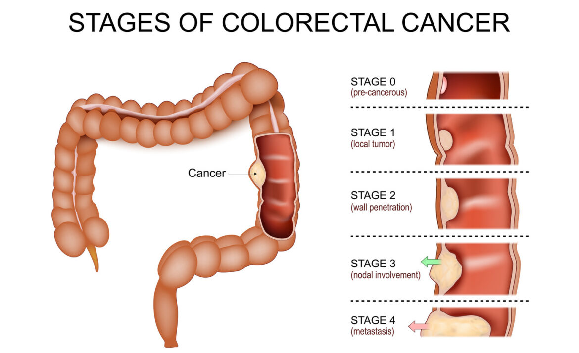 Frequently Asked Questions about Colorectal Cancer Screening