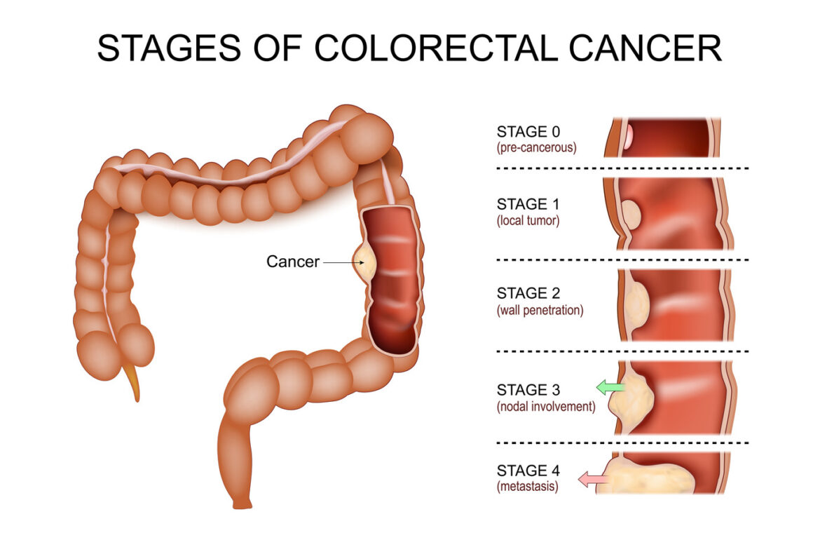 Frequently Asked Questions about Colorectal Cancer Screening