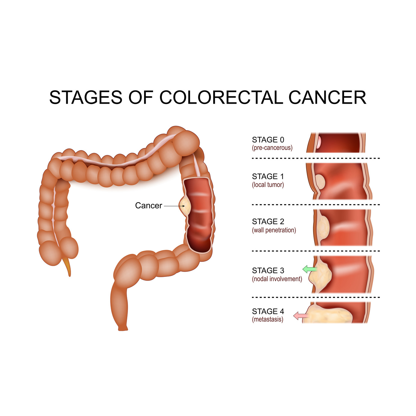 Don’t Wait: Why Colon Cancer Screening at 45 Matters More Than Ever