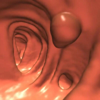 Colon and rectal cancer screenings