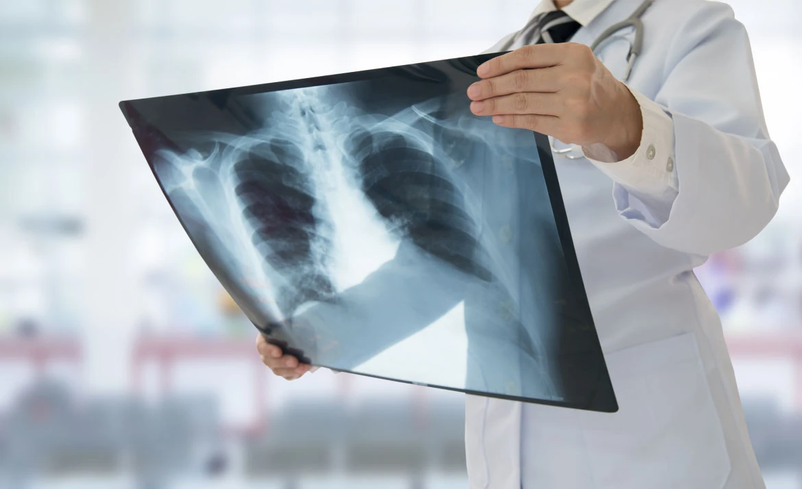 doctor holding lungs Xray