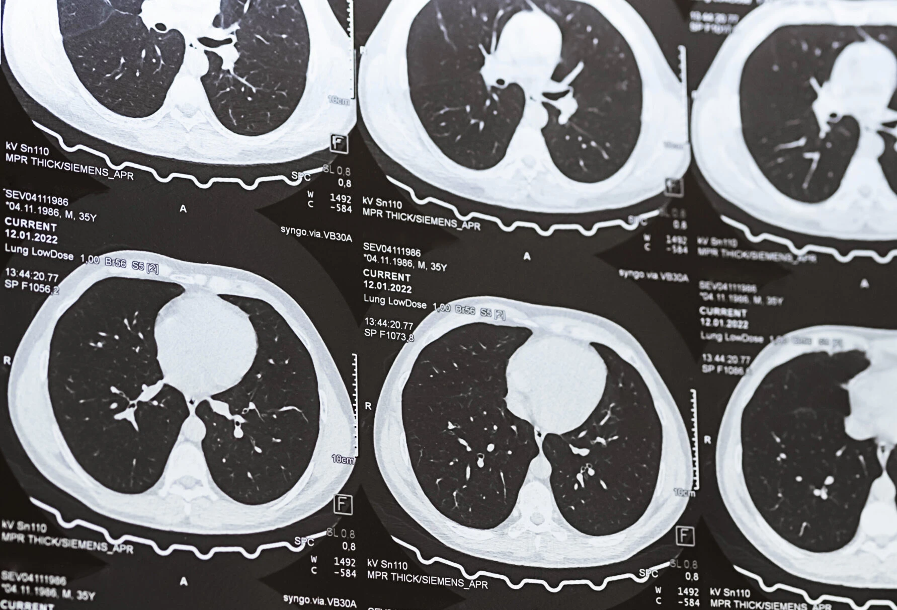 CT Lung lsgimaging