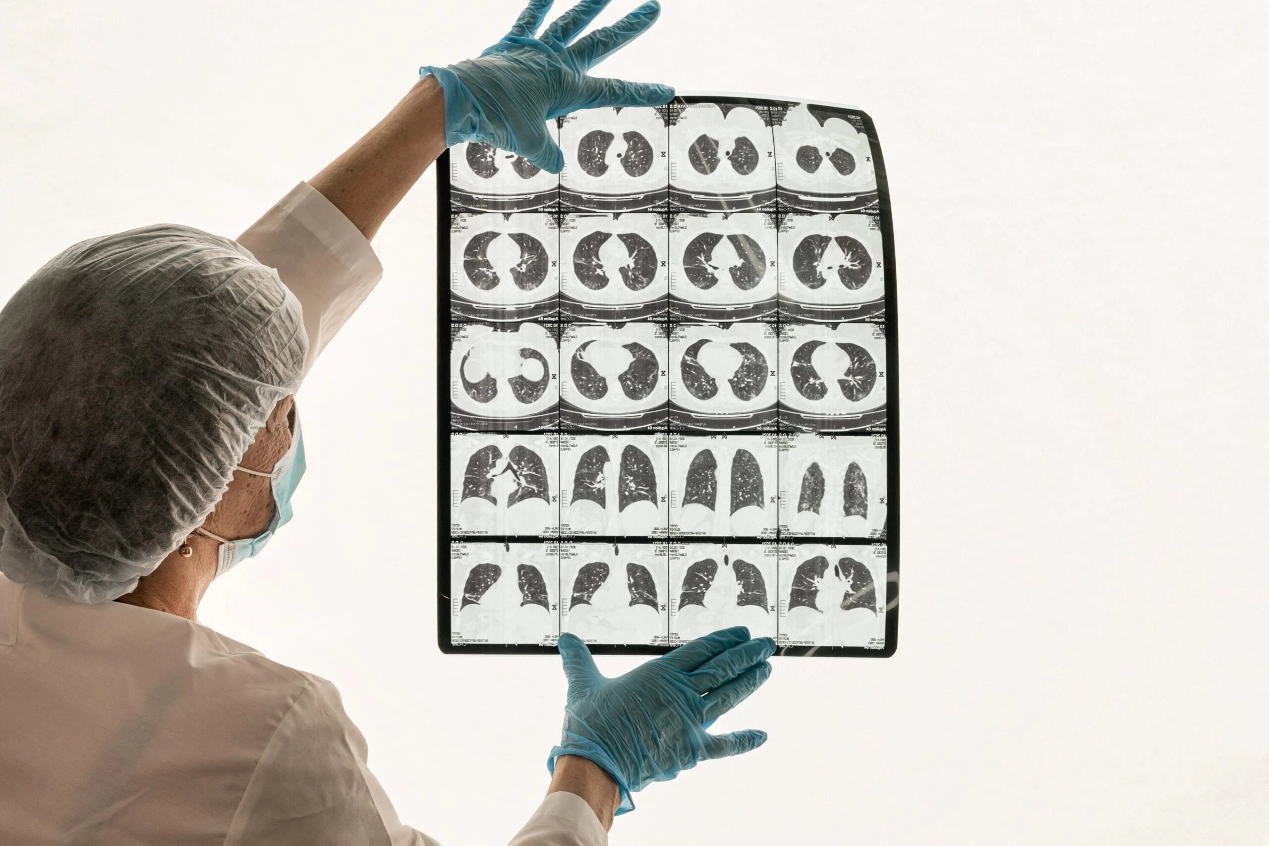 Benefits of CT Lung Screening in Beverly Hills