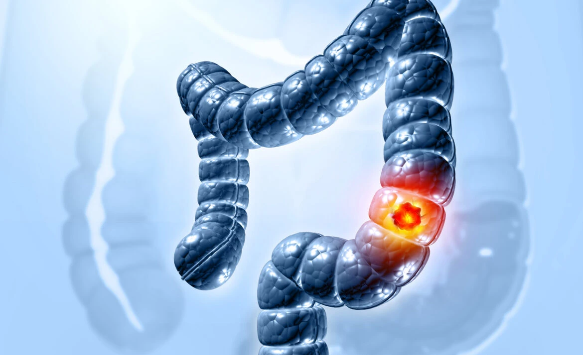 virtual colonoscopy Beverly Hills