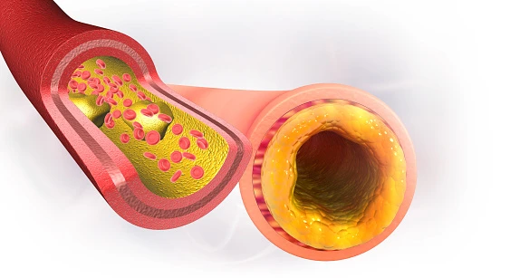 What Does a CT Coronary Calcium Score Check Show