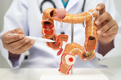 Colorectal cancer